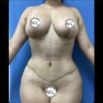 Abdominoplasty Before & After Patient #14853