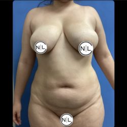 Abdominoplasty Before & After Patient #14853