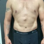 Abdominoplasty Before & After Patient #14787