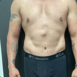Abdominoplasty Before & After Patient #14787