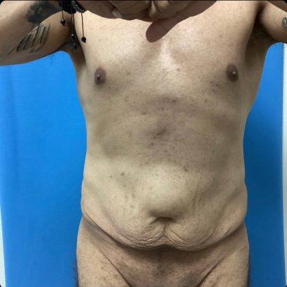 Abdominoplasty Before & After Patient #14873