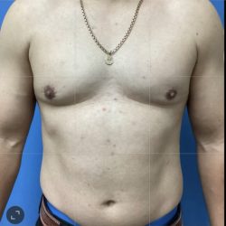 Gynecomastia Before & After Patient #14872