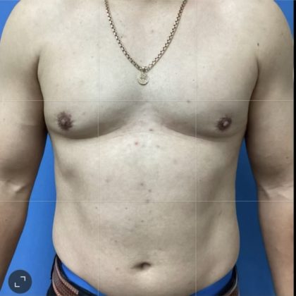 Gynecomastia Before & After Patient #14872