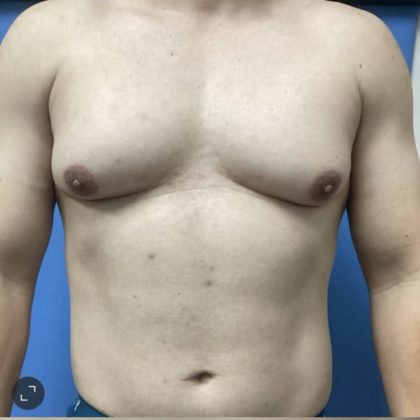 Gynecomastia Before & After Patient #14872
