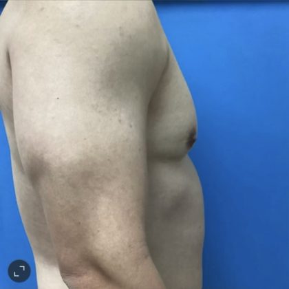 Gynecomastia Before & After Patient #14872