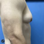 Gynecomastia Before & After Patient #14872