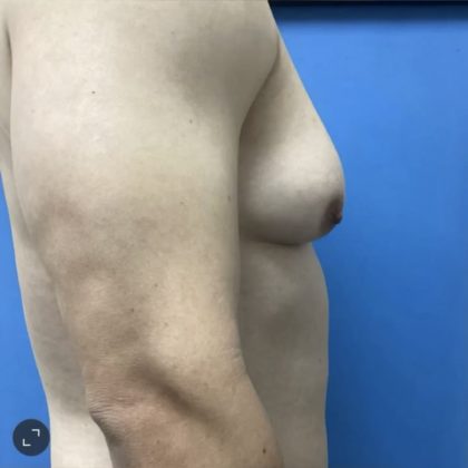 Gynecomastia Before & After Patient #14872