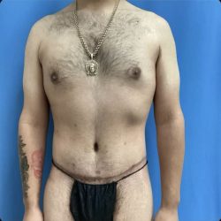 Gynecomastia Before & After Patient #14871