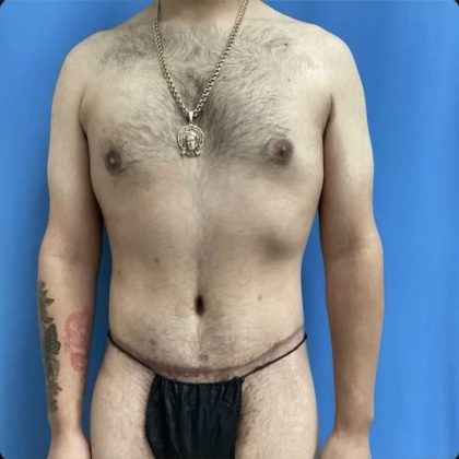 Gynecomastia Before & After Patient #14871