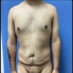Gynecomastia Before & After Patient #14871