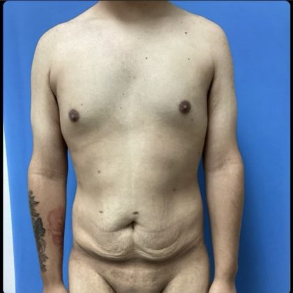 Gynecomastia Before & After Patient #14871