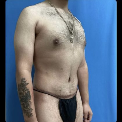 Gynecomastia Before & After Patient #14871
