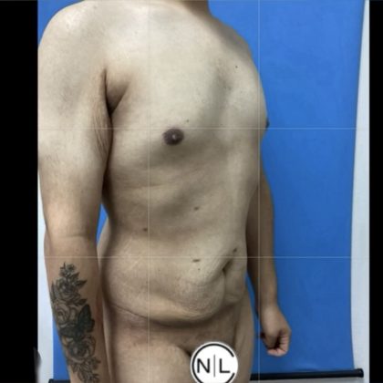 Gynecomastia Before & After Patient #14871