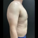Abdominoplasty Before & After Patient #14870