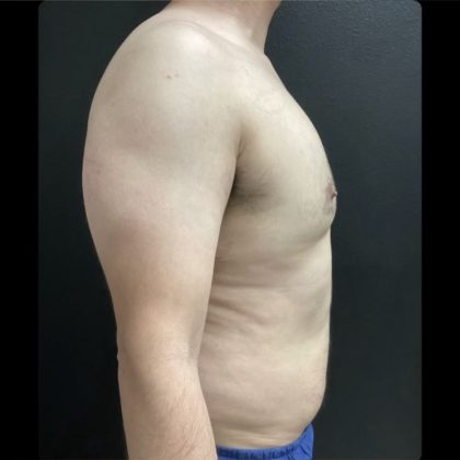 Gynecomastia Before & After Patient #14793