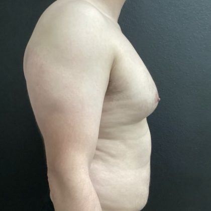 Gynecomastia Before & After Patient #14793