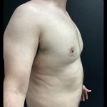 Abdominoplasty Before & After Patient #14870