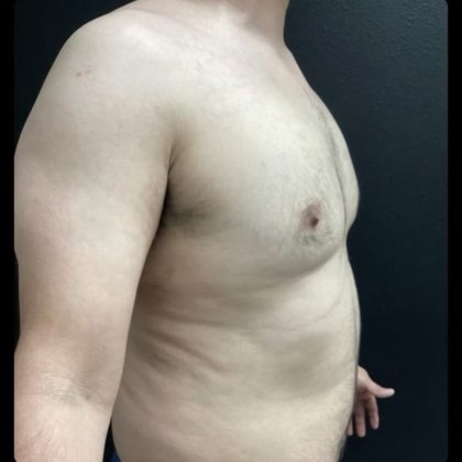 Gynecomastia Before & After Patient #14793