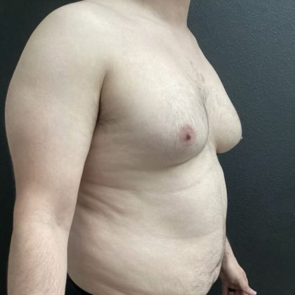 Gynecomastia Before & After Patient #14793