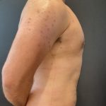Gynecomastia Before & After Patient #14869