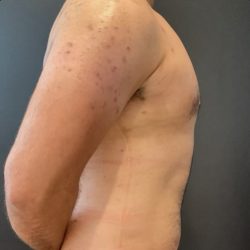 Gynecomastia Before & After Patient #14869