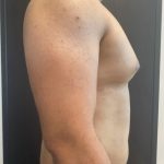 Gynecomastia Before & After Patient #14869