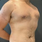 Gynecomastia Before & After Patient #14869