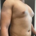 Gynecomastia Before & After Patient #14869