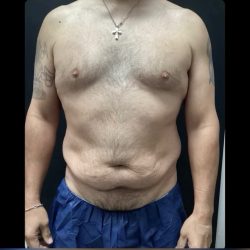 Abdominoplasty Before & After Patient #14795