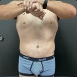Abdominoplasty Before & After Patient #14795