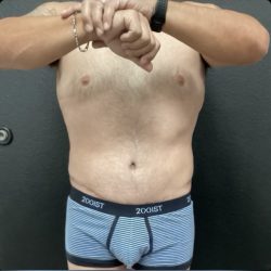Abdominoplasty Before & After Patient #14795