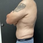 Abdominoplasty Before & After Patient #14795