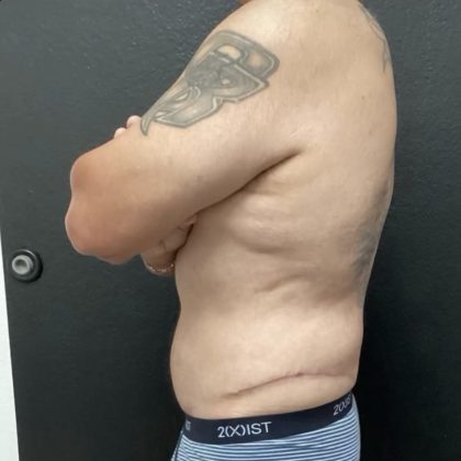 Abdominoplasty Before & After Patient #14795