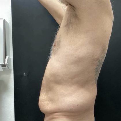 Abdominoplasty Before & After Patient #14795