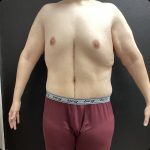 Abdominoplasty Fleur-de-lis Before & After Patient #14799