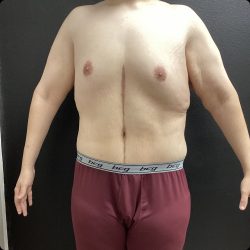Abdominoplasty Fleur-de-lis Before & After Patient #14799