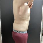 Abdominoplasty Fleur-de-lis Before & After Patient #14799