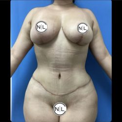 Breast Reduction Before & After Patient #14846
