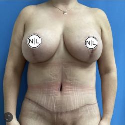 Mommy Makeover Before & After Patient #14852