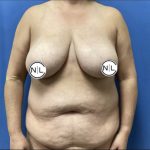 Mommy Makeover Before & After Patient #14852