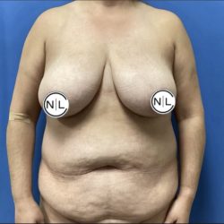 Mommy Makeover Before & After Patient #14852