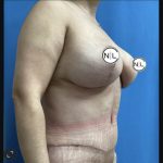 Mommy Makeover Before & After Patient #14852