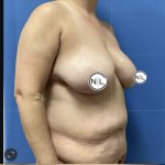 Mommy Makeover Before & After Patient #14852