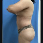 Abdominoplasty Before & After Patient #14851