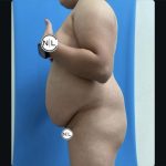 Abdominoplasty Before & After Patient #14851