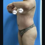 Abdominoplasty Before & After Patient #14851