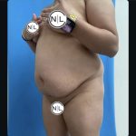 Abdominoplasty Before & After Patient #14851