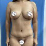 Mommy Makeover Before & After Patient #14850