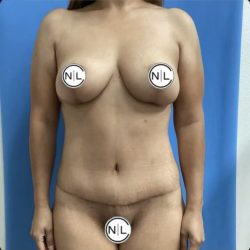 Mommy Makeover Before & After Patient #14850