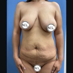 Mommy Makeover Before & After Patient #14850